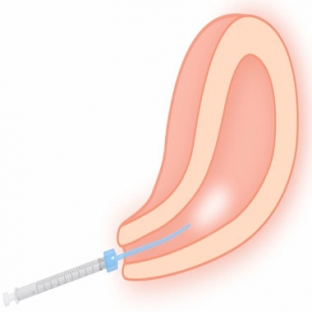人工授精用カテーテル 【使用例】人工授精(IUI)における精子調整